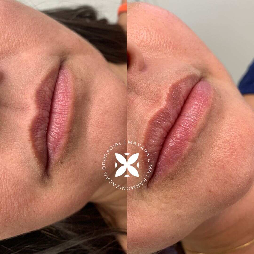 Paciente 4 Antes Depois Preenchimento Labial Florianópolis SC Dra. Mayara Lima