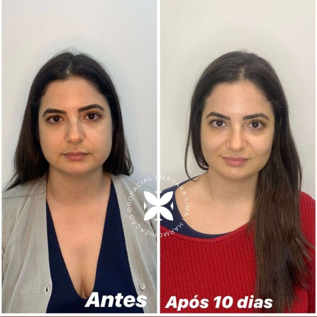 Caso 5 de Antes e Depois Bichectomia em Florianópolis
