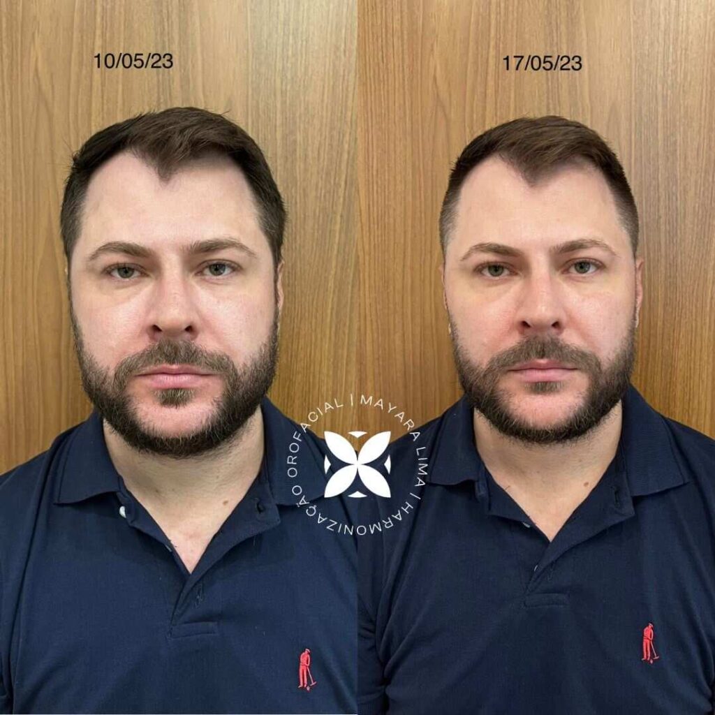 Antes e depois da cirurgia de Bichectomia em Florianópolis SC com a Dra. Mayara Lima