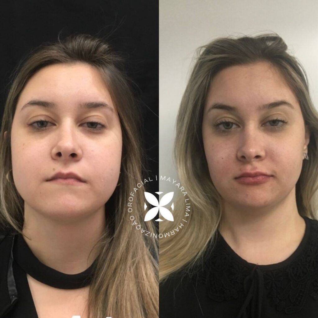 Caso de Antes e Depois Bichectomia em Florianópolis