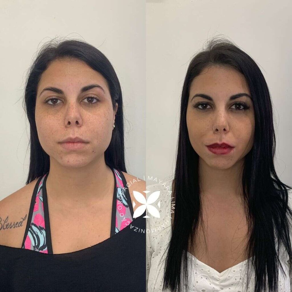 Bichectomia Antes e Depois com a Dra. Mayara Lima em Florianópolis