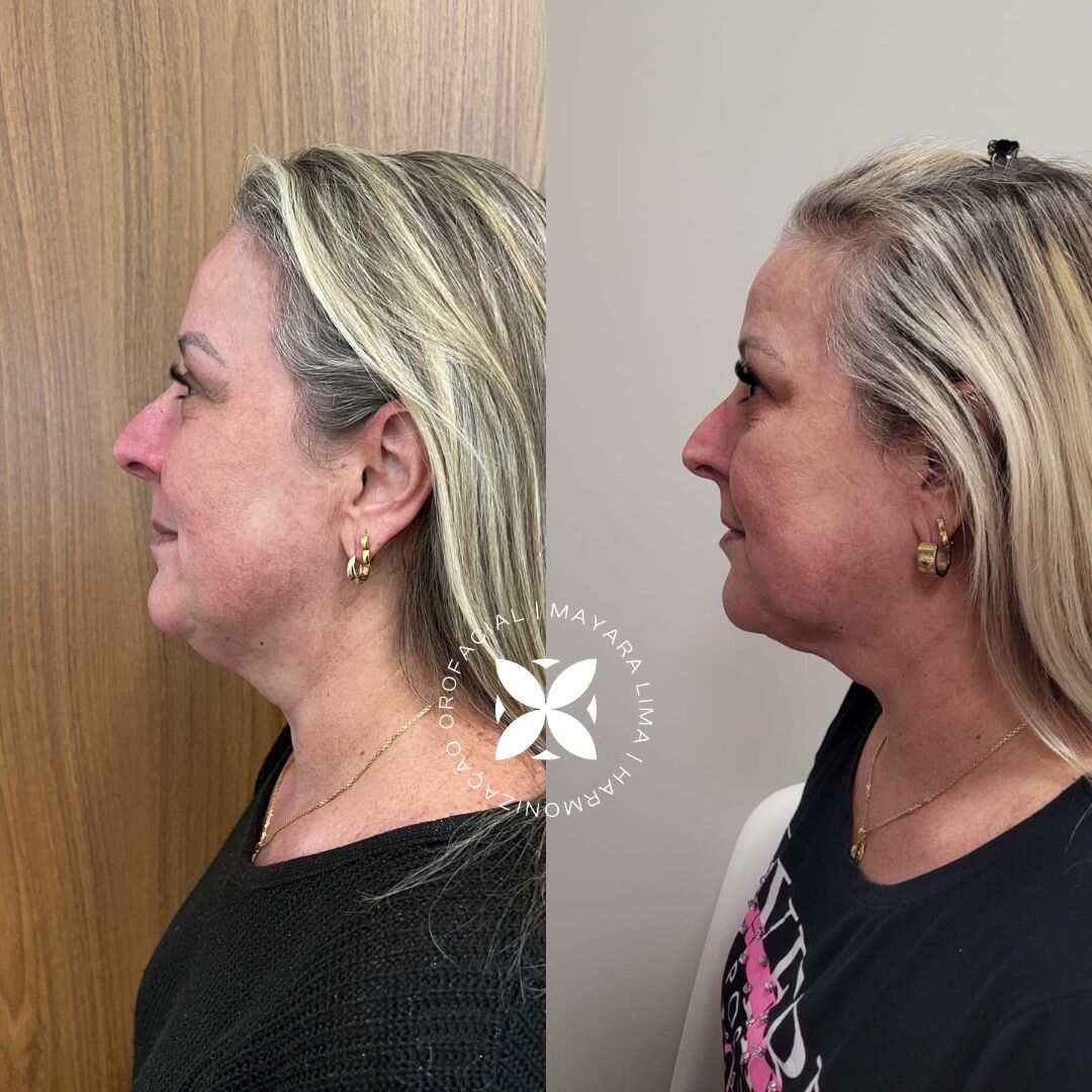 Antes e Depois Lipo de papada Florianópolis SC com Dra. Mayara Lima