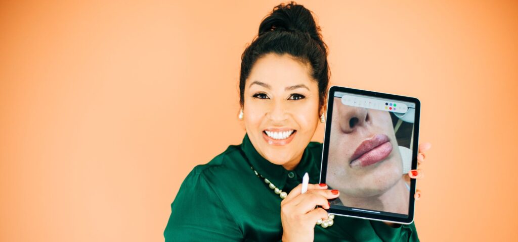 Preenchimento Labial em Florianópolis Dra. Mayara Lima