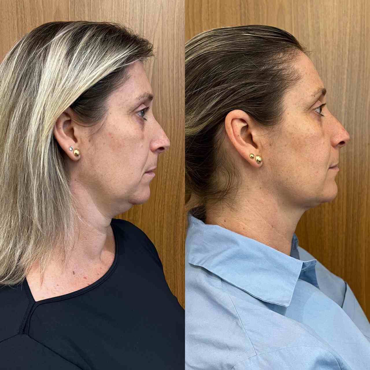 PAciente Antes e Depois Lipo Papada em Florianópolis 1