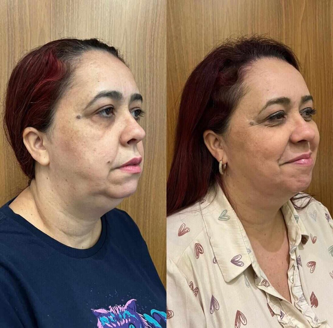 Antes e Depois Lipo Papada em Florianópolis 2