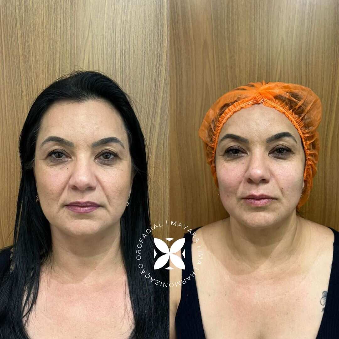 Caso 4 Antes e Depois Bichectomia em Florianópolis com a Dra. Mayara Lima