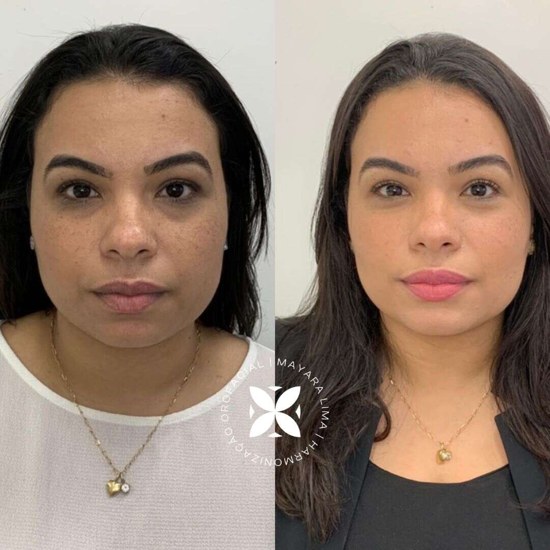 Caso 5 Antes e Depois Bichectomia em Florianópolis