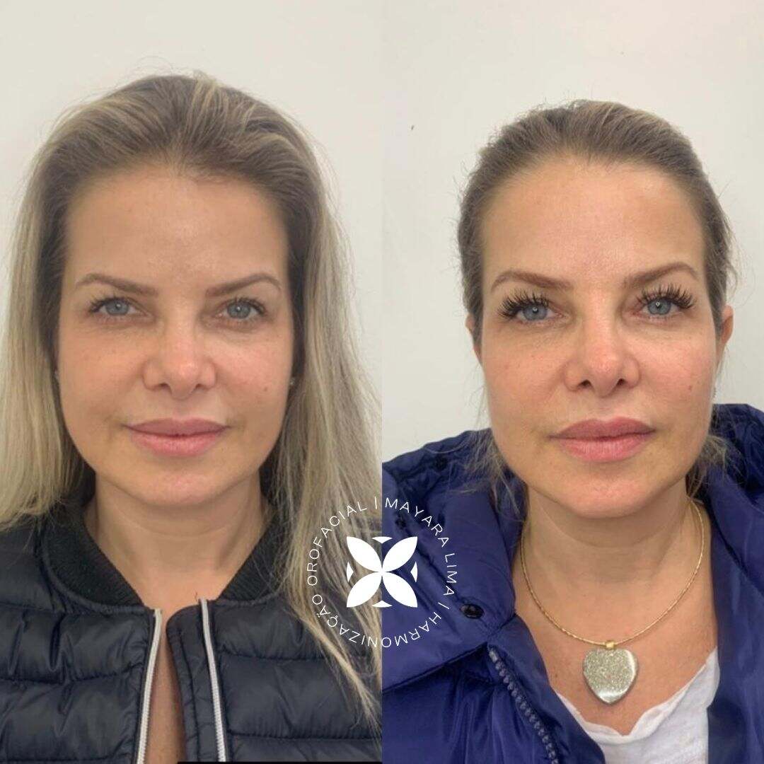 Caso 6 Antes e Depois Bichectomia em Florianópolis