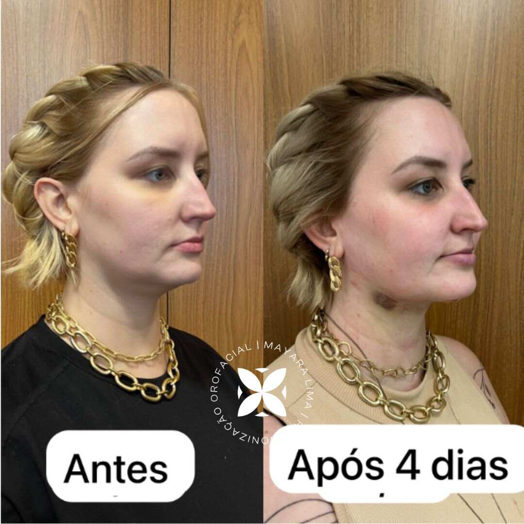 Lipo de Papada_Antes e Depois Florianópolis-SC