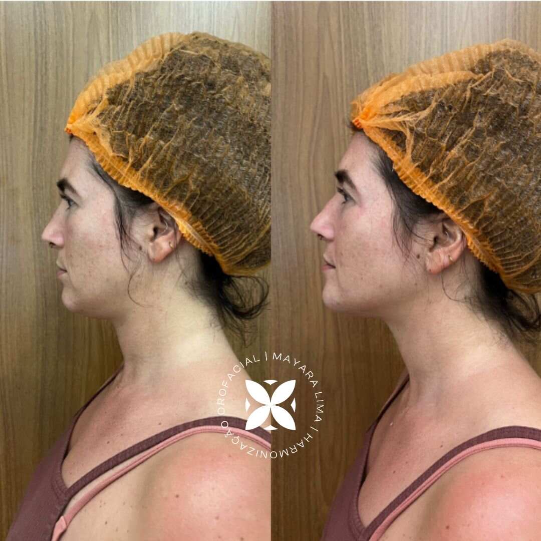 Paciente15 Antes e Depois da Lipoaspiração de papada em Florianópolis-SC