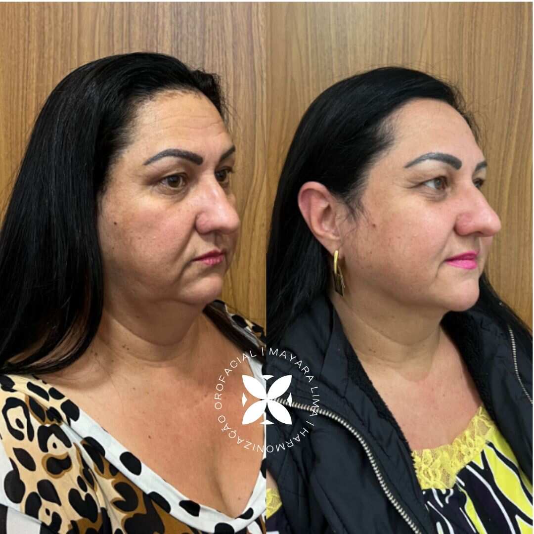 Paciente16 Antes e Depois Lipoaspiraçõa de papada em Florianópolis-SC