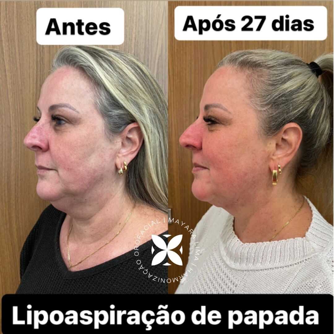 Paciente com 27dias Antes e Depois Lipoaspiração de papada em Florianópolis-SC