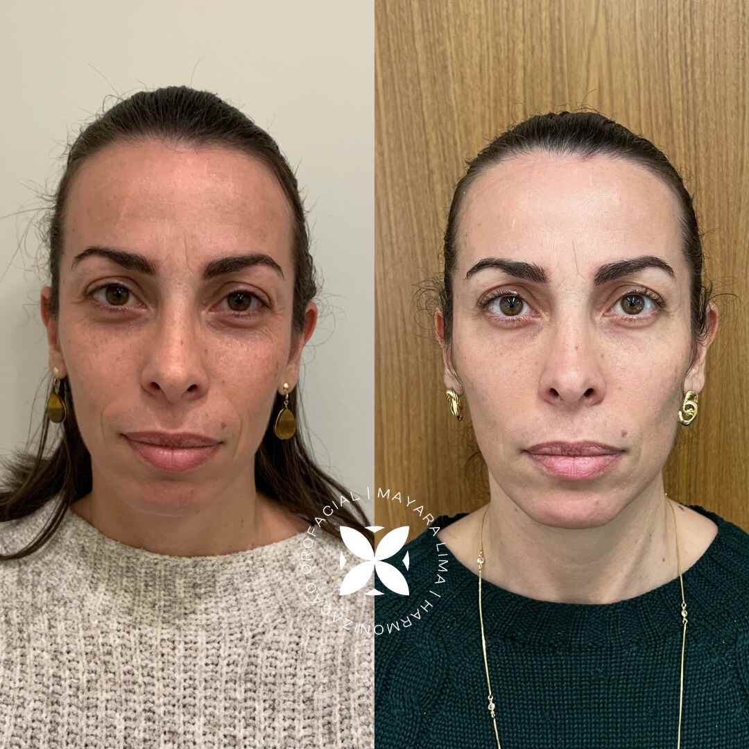 Antes e Depois Paciente 2 Tratamento de Olheiras em Florianópolis