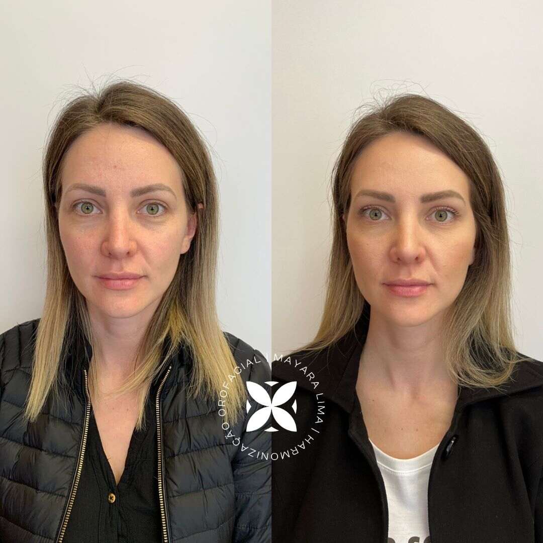 Antes e Depois Paciente 5 Tratamento de Olheiras em Florianópolis