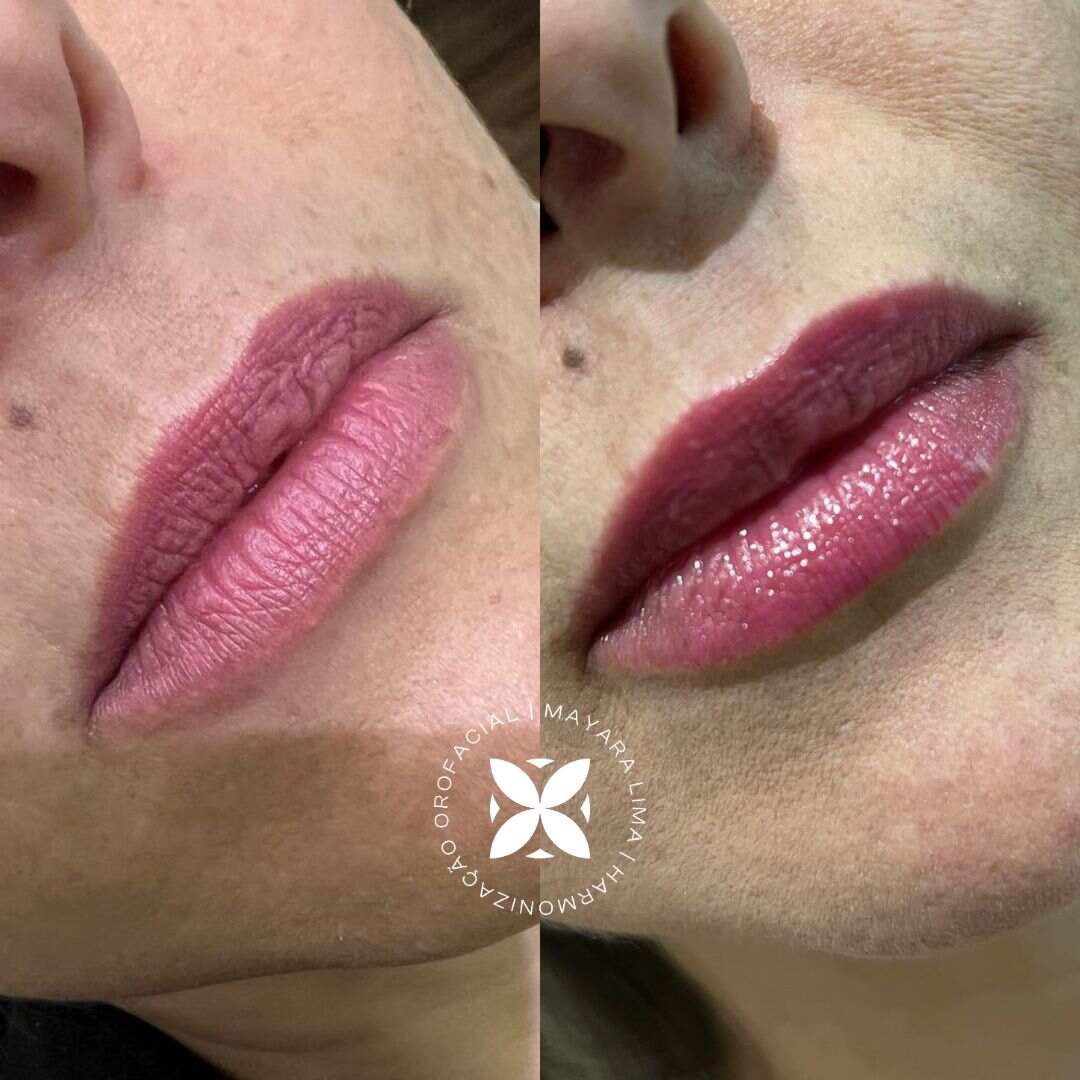 Paciente 3 Antes Depois Preenchimento Labial Florianópolis Dra. Mayara Lima