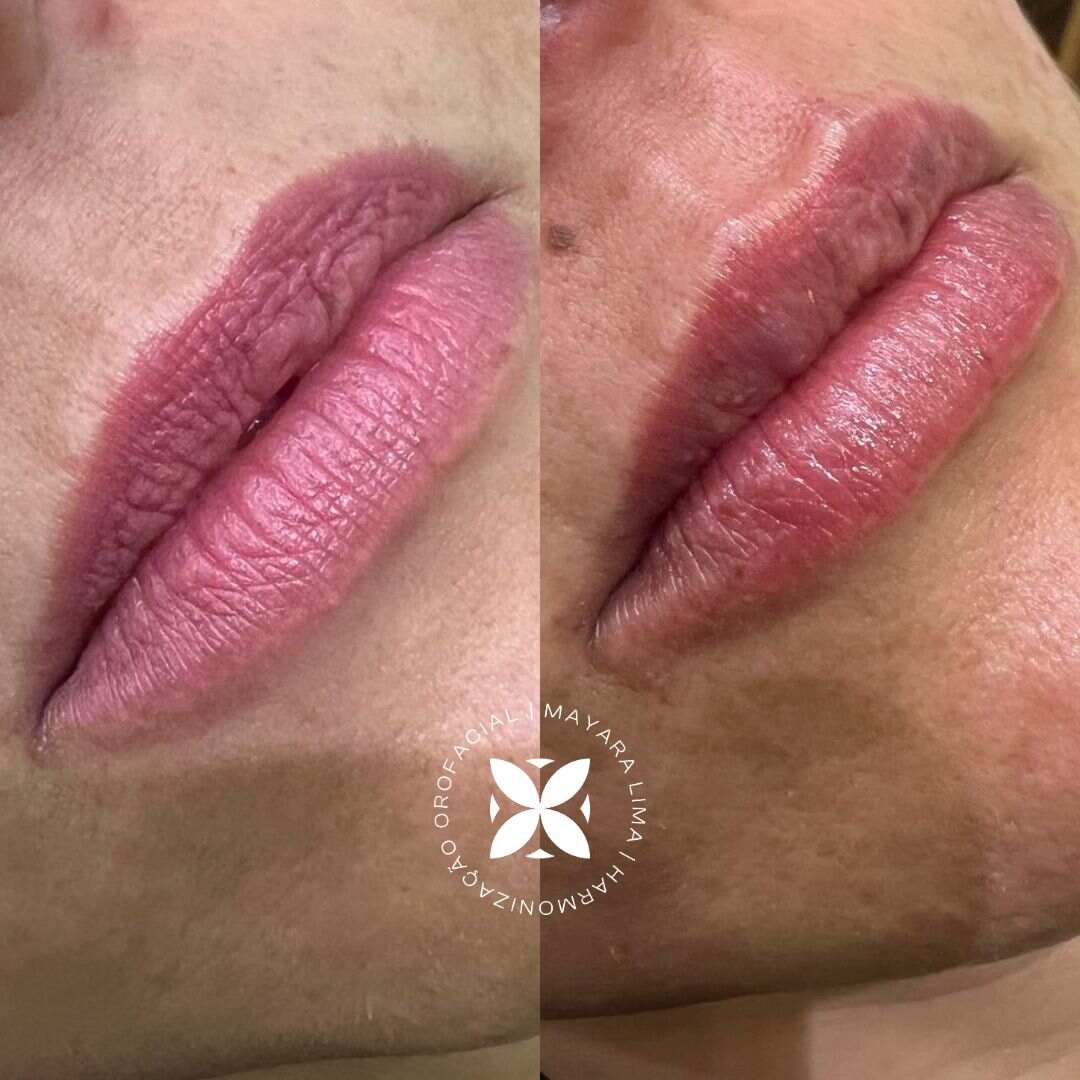 Paciente 2 Antes Depois Preenchimento Labial Florianópolis Dra. Mayara Lima