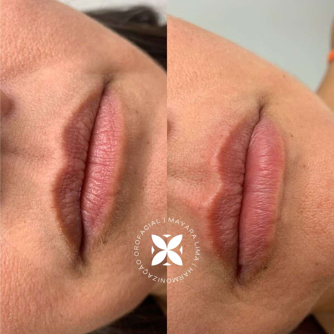 Paciente Antes Depois Preenchimento Labial Florianópolis Dra. Mayara Lima