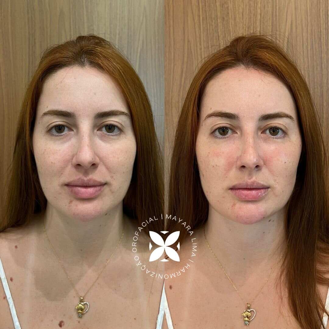 Antes e Depois Paciente 1 Tratamento de Olheiras em Florianópolis