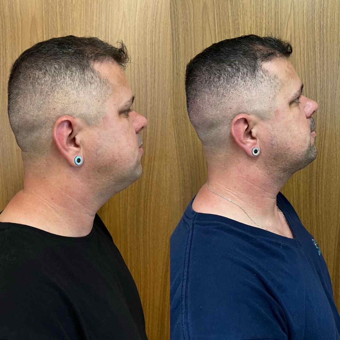 Paciente Homem Antes E Depois Lipoaspiração de papada em Florianópolis-SC