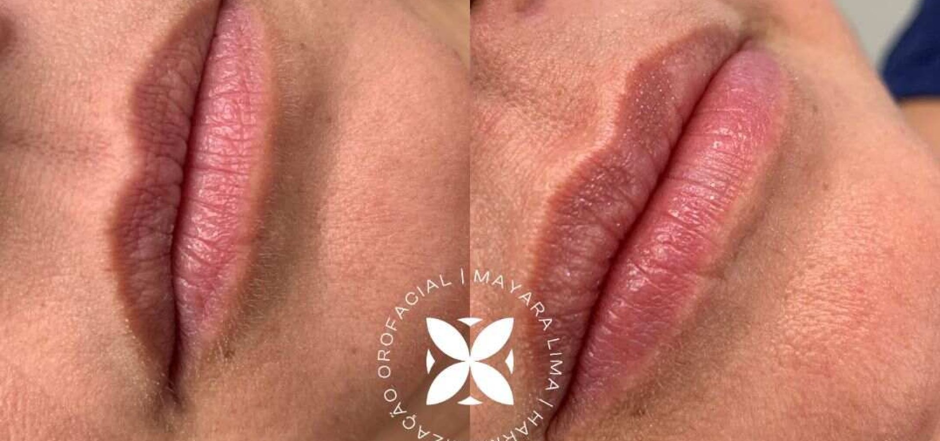 Paciente 4 Antes Depois Preenchimento Labial Florianópolis SC Dra. Mayara Lima