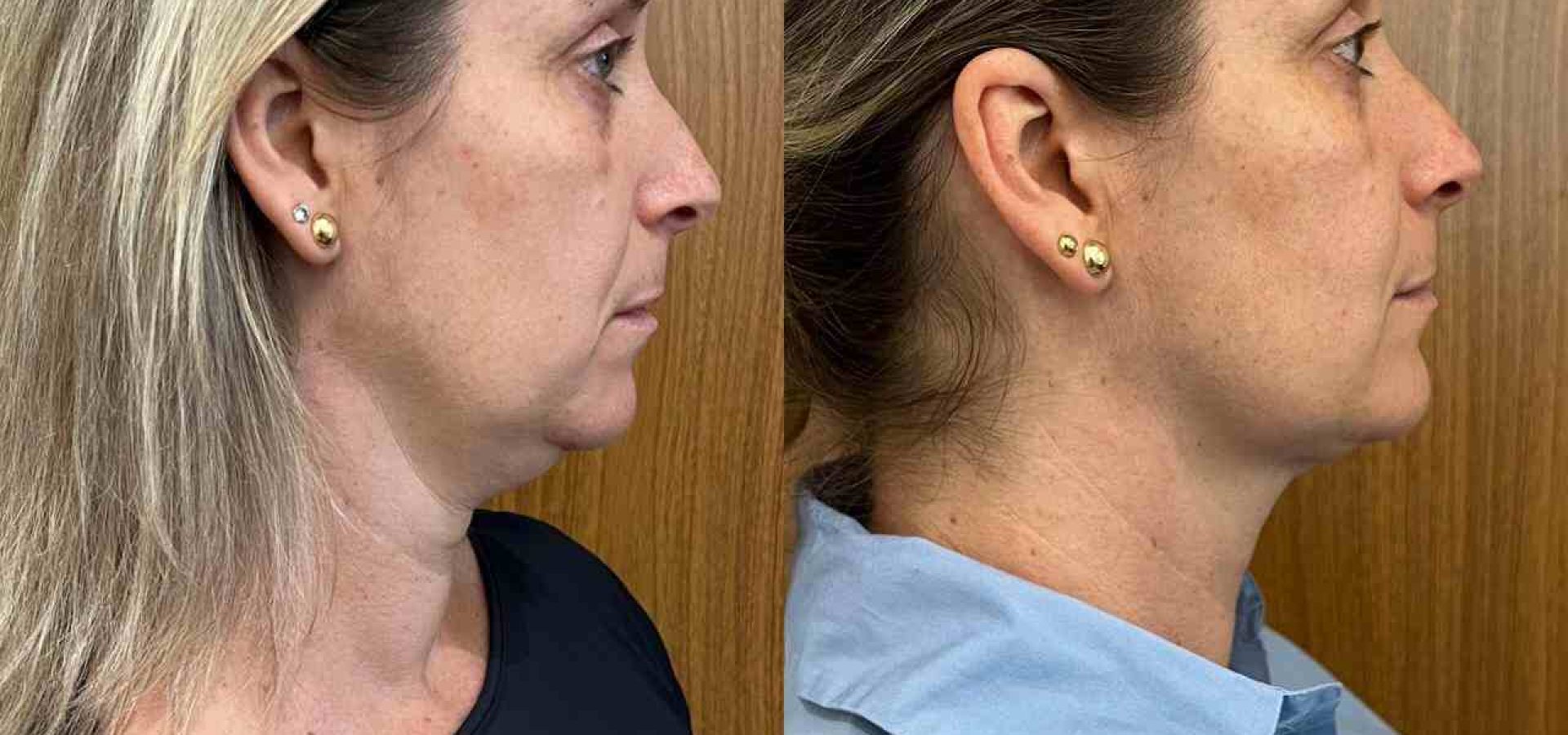 PAciente Antes e Depois Lipo Papada em Florianópolis 1