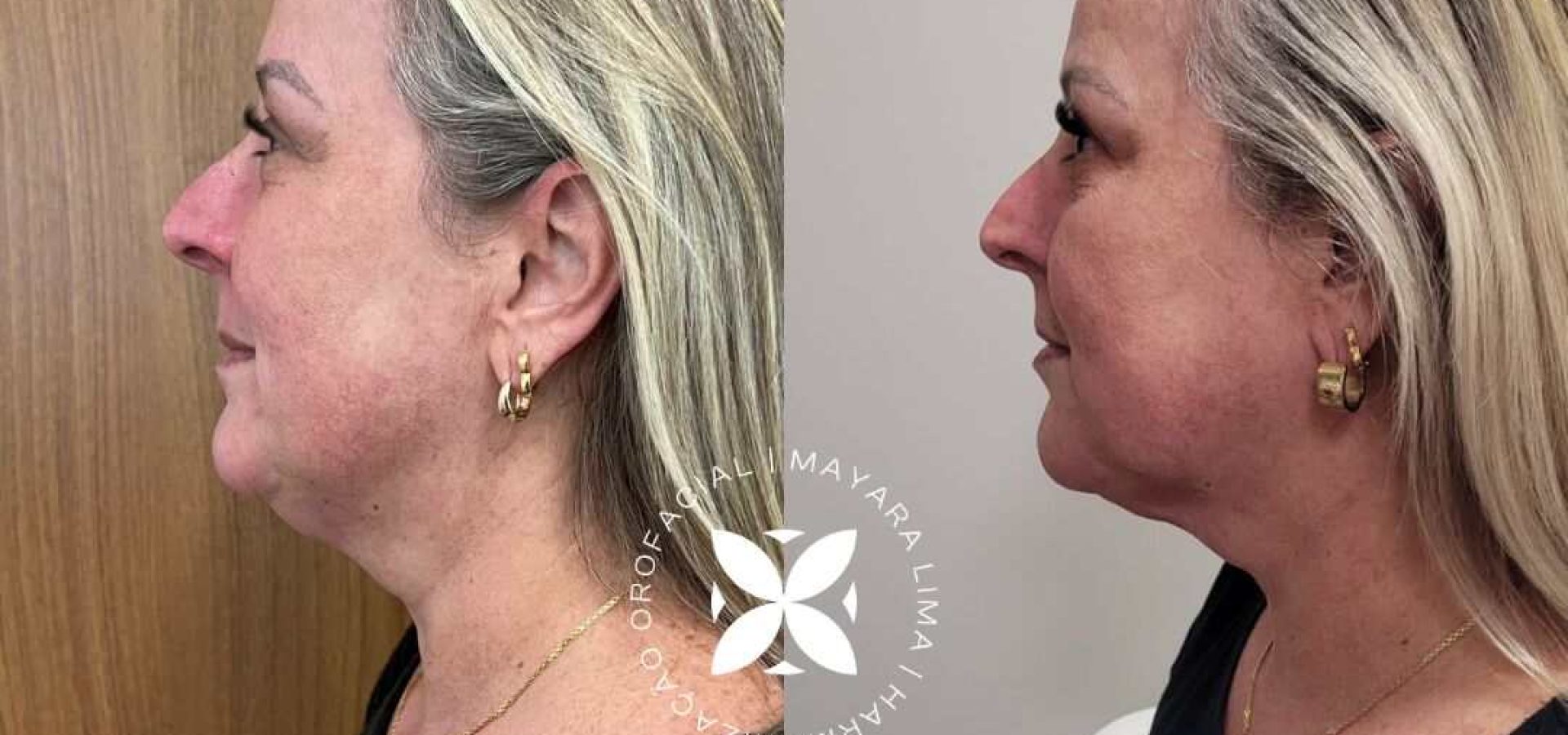 Antes e Depois Lipo de papada Florianópolis SC com Dra. Mayara Lima