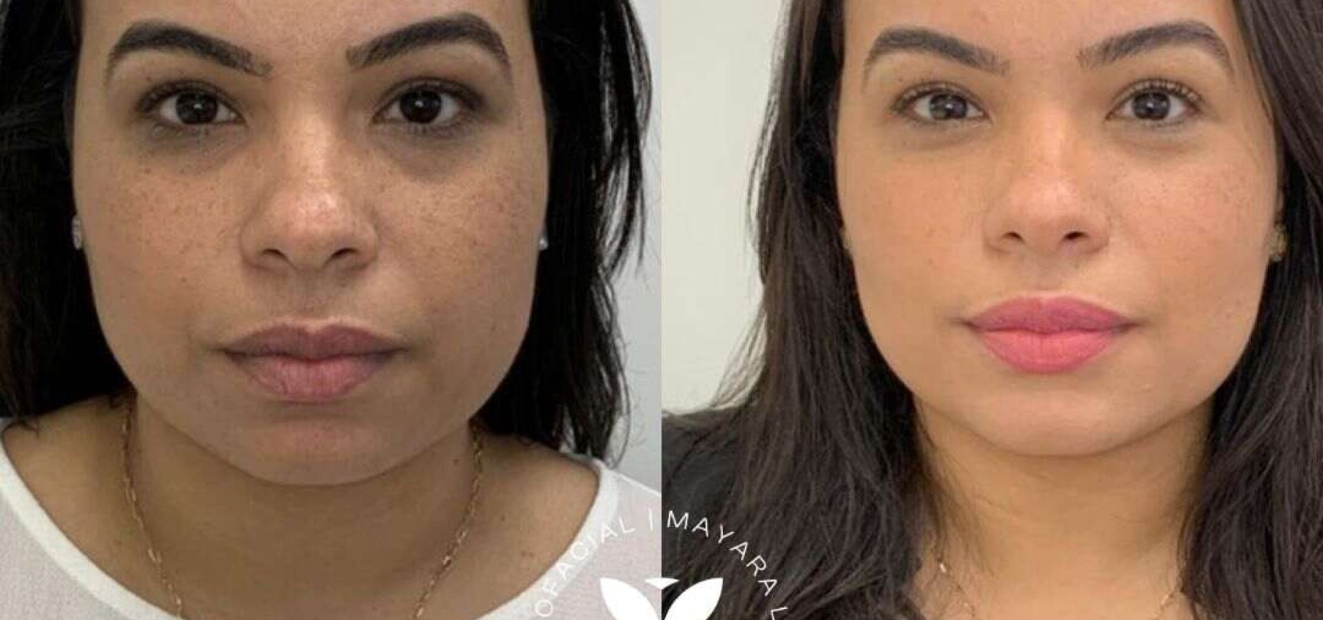 Caso 5 Antes e Depois Bichectomia em Florianópolis