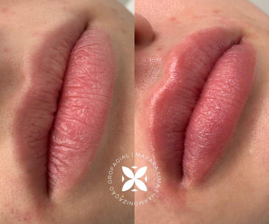 Paciente Antes Depois Preenchimento Labial Florianópolis-SC Dra. Mayara Lima