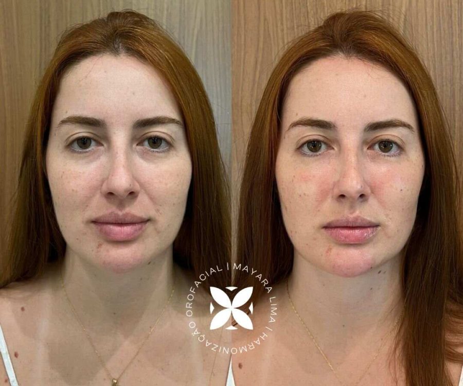 Antes e Depois Paciente 1 Tratamento de Olheiras em Florianópolis