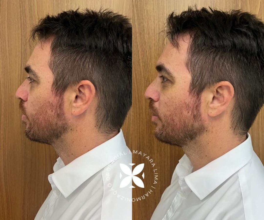 Paciente Preenchimento Queixo Antes e Depois em Florianópolis SC