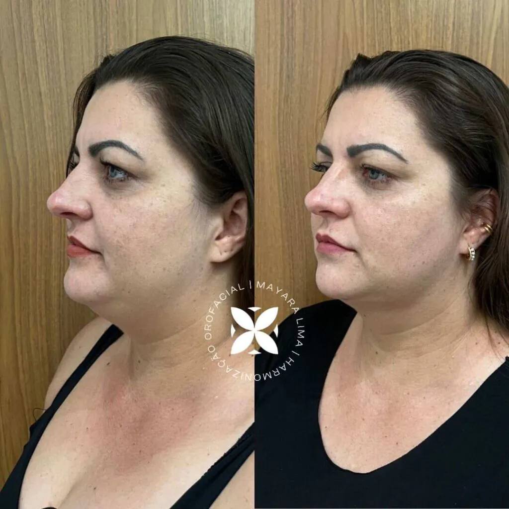 Antes e Depois Lipoaspiração de papada Florianópolis Sc Paciente2 Dra. Mayara Lima