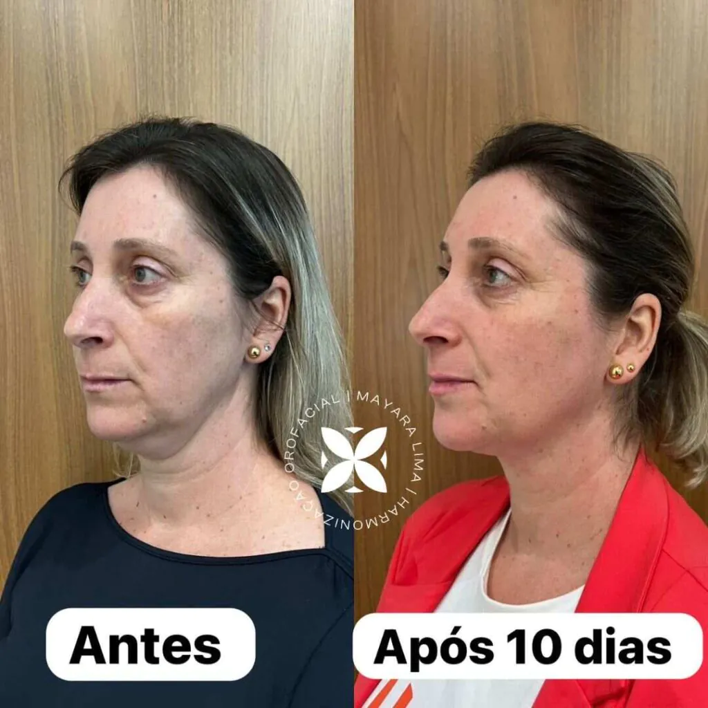 Antes e Depois Lipo de papada Florianópolis Sc Paciente4 Dra. Mayara Lima